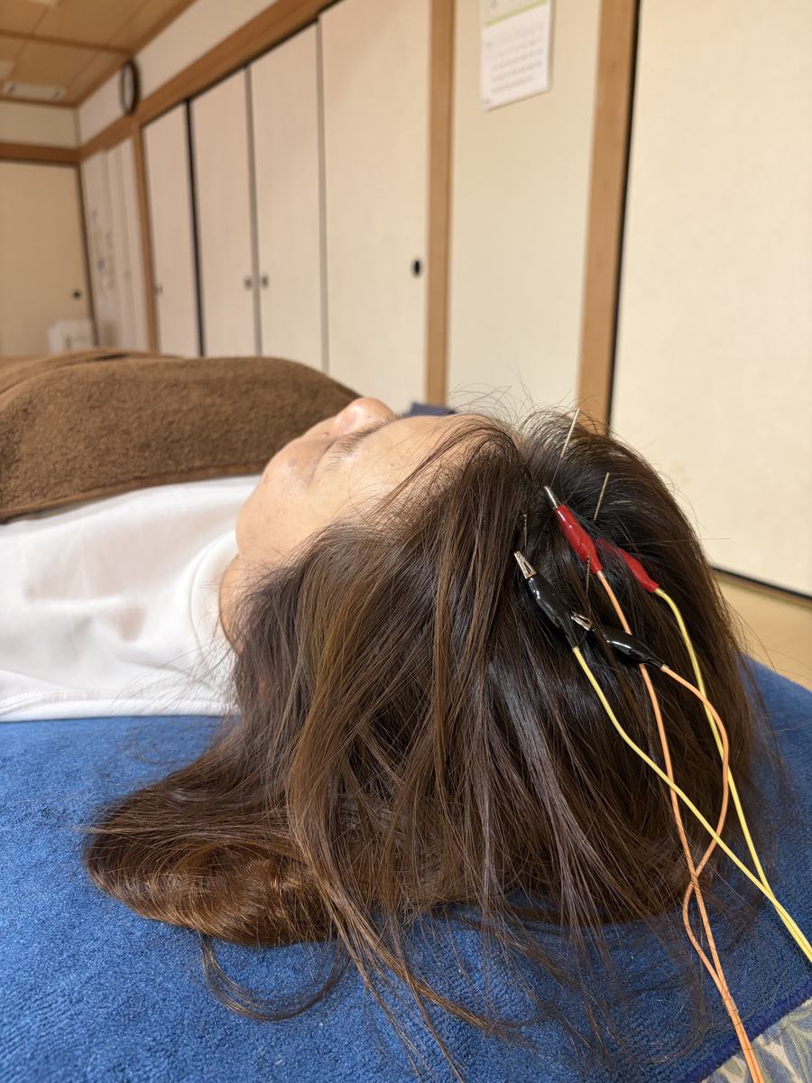 頭皮への鍼と低周波通電の施術風景